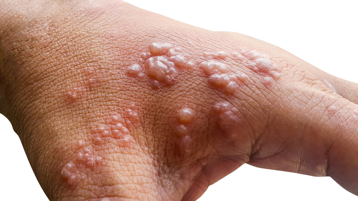 Officials confirm two cases of monkeypox detected in Islamabad, originating from Saudi Arabia